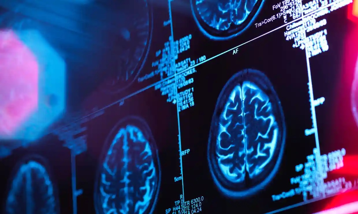 Un medicamento retrasa el deterioro cognitivo de los pacientes con Alzheimer, revela un estudio
