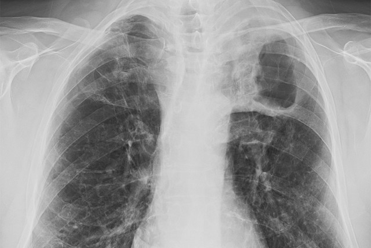 1 de cada 10 casos sospechosos de tuberculosis da positivo en Tabasco, alertan autoridades