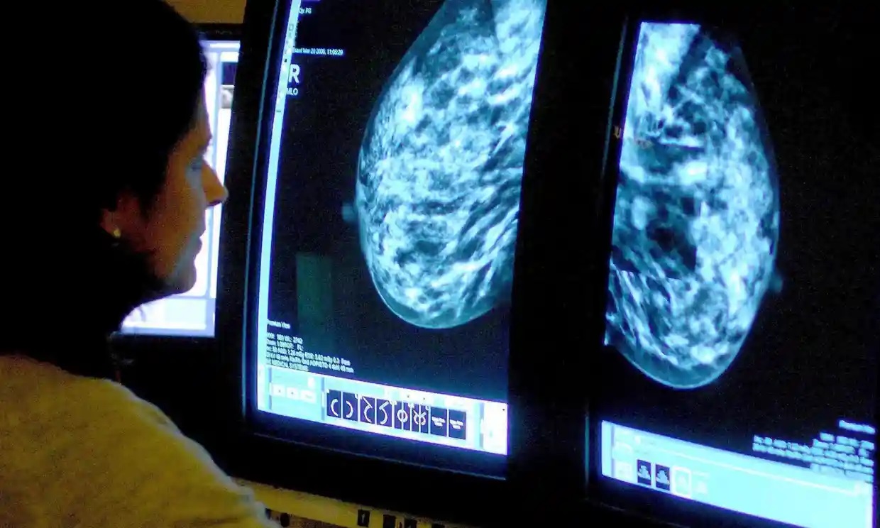 La mayoría de las pacientes con cáncer de mama inicial serán supervivientes a largo plazo, dice estudio