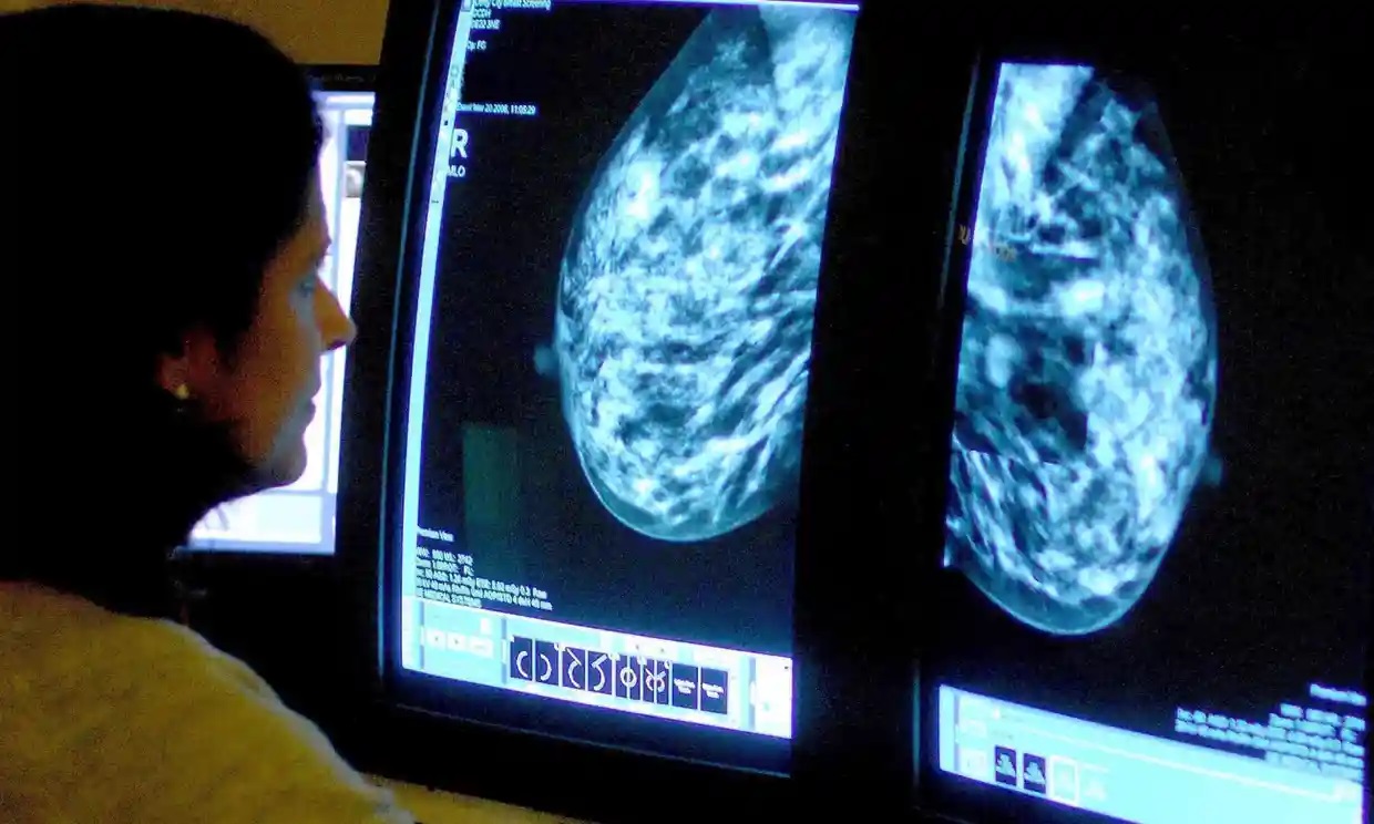 Medicamento contra cáncer de mama reduce en 25% riesgo de reaparición